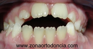Chupete y alteraciones dentarias - Amalia Arce